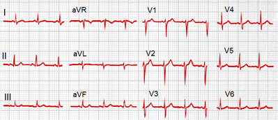 ECG normal.png