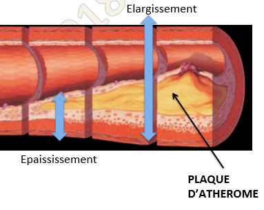 Athérosclérose.png