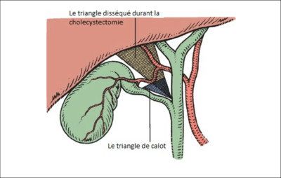 le-triangle-de-calot-en-bleu-selon-la-description-originale-de-J-FCalot-en-1891-et.png