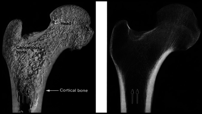 Bone-section-left-and-radiograph-right-of-the-proximal-femur-in-the-frontal-plane.png