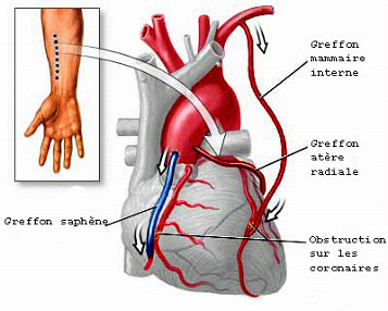 pontage-artere-radiale.jpg