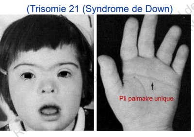 trisomie 21.PNG