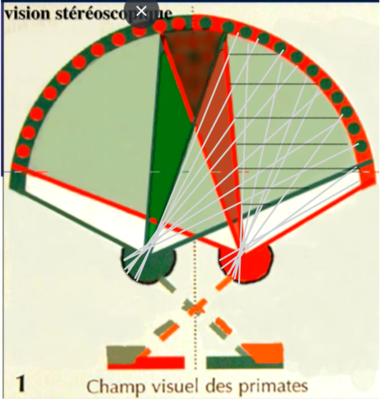 champ visuel lésion 3 bis.png