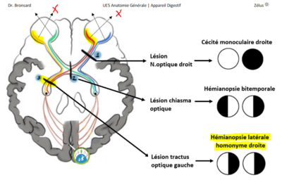 Hémianopsie.PNG