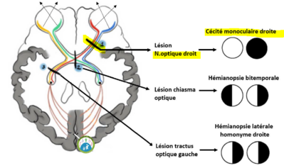 cécité mono.PNG